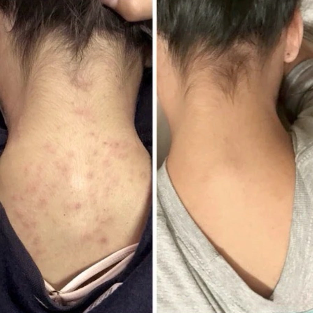 Body Glow Routine for Breakouts, Texture & Dark Marks™