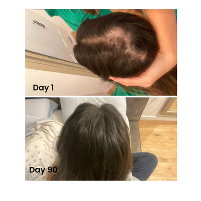 I have hair where there was no hair
